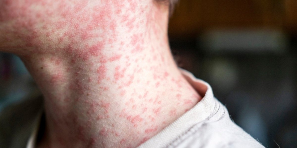 Sve o tifusu: Zaraza se brzo širi, prvi simptomi se pojave tek posle 7 dana - Ishod može biti fatalan