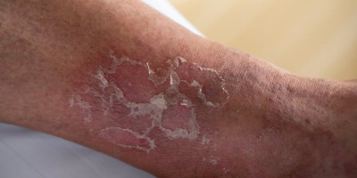 Koža često prva pokazuje da organizmu nešto fali. Sitne promene na licu, usnama ili telu mogu biti znak nedostatka važnih vitamina i minerala.