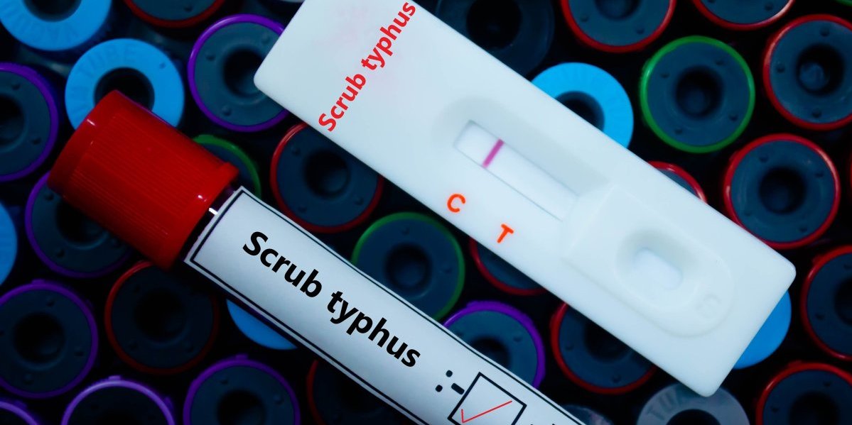 Balkan u strahu od tifusa: Smatrao se iskorenjenim, a onda se vratio - Jedna stvar zabrinjava