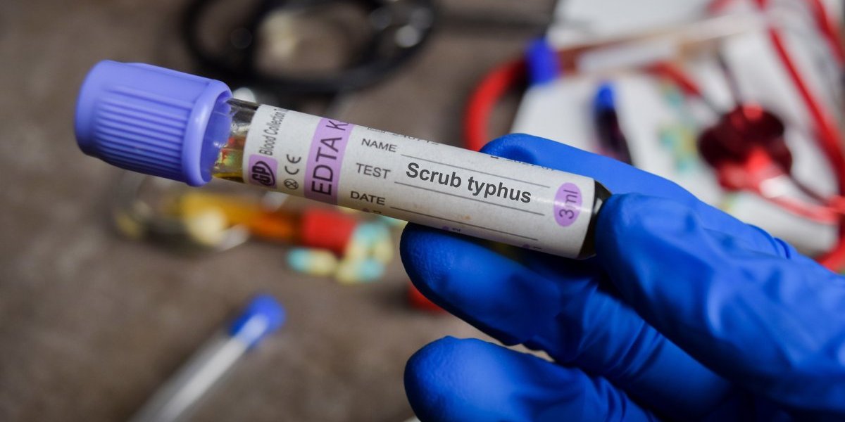 Studentkinja je kliconoša tifusa: Simptomi su jezivi, a ishod može biti fatalan - Evo da li Srbiji preti nova epidemija