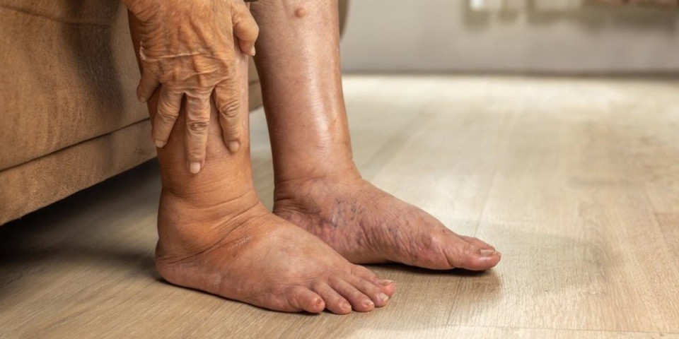 Oticanje nogu nije bezazleno: Telo vam šalje upozorenje - ovo je simptom opasnih bolesti