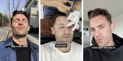 Sperma lososa za negu lica postala je svetski hit, a Niki Kelvin je u Južnoj Koreji isprobao čak 700 injekcija za podmlađivanje kože - tajni recept slavnih za vječno mladolik izgled.