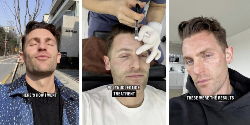 Ubrizgao u lice spermu lososa: Tretman zgrozio milione - ubadali ga više od 700 puta (VIDEO)