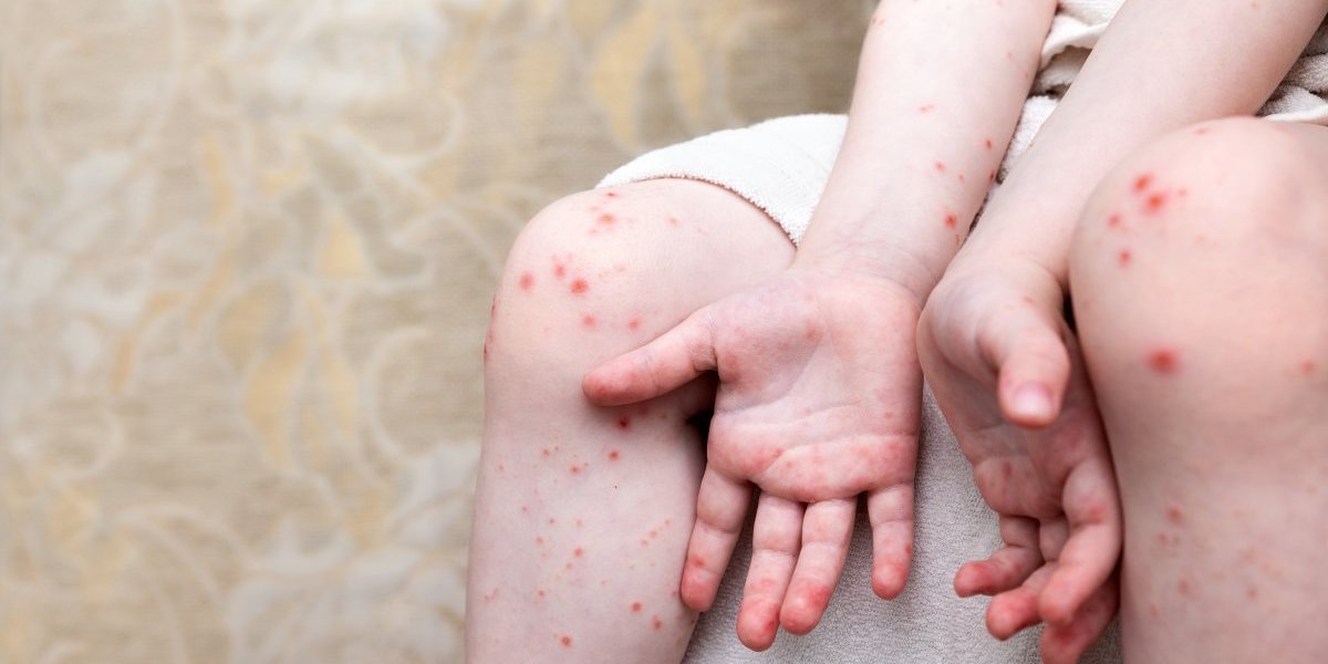 Roditelji pomisle da su boginje, međutim... Opasan "američki" virus kosi decu u Srbiji