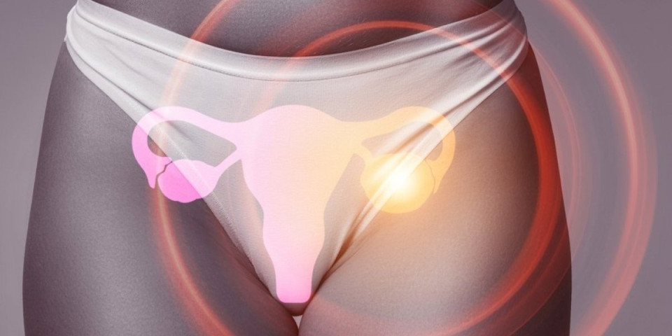 Policistični jajnici nisu samo ginekološki problem: Evo do čega još mogu da dovedu – ne bira kilažu