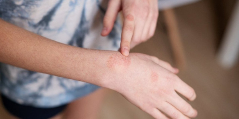 Noću vas svrbi koža? Nikako ne ignorišite ovaj simptom, može biti znak opake bolesti