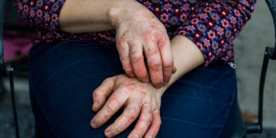 Atopijski dermatitis, najčešći oblik ekcema, pogađa milione ljudi širom sveta, izazivajući uporan svrab, suvu i upaljenu kožu. Iako ne postoji trajni lek, svakodnevne navike mogu znatno ublažiti simptome i poboljšati kvalitet života.