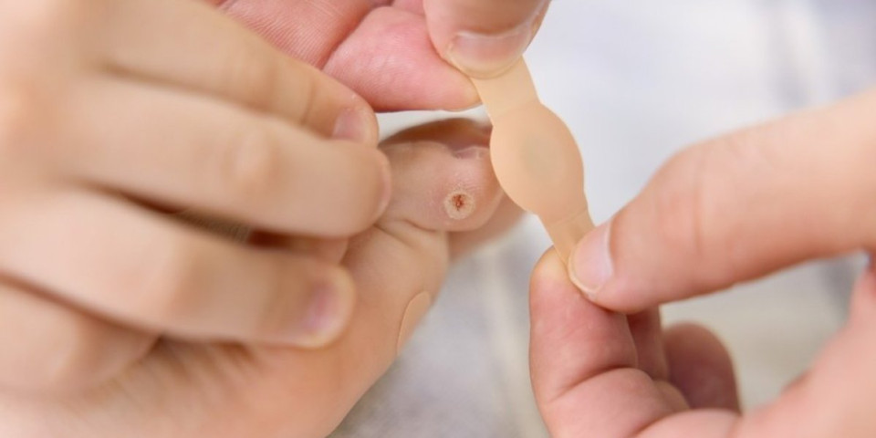 Kurje oko kao napast: Evo kako da ublažite tegobe