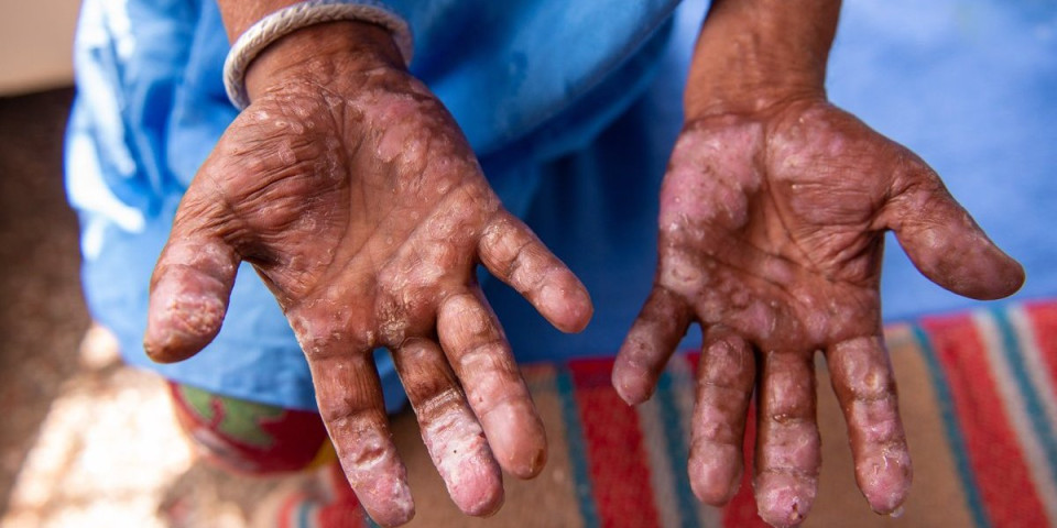 Alarmantno: Balkan na nogama - U ove dve zemlje otkrivena opasna zaraza