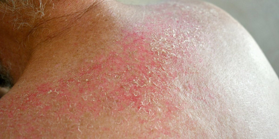 Povratak gube uzdrmao Balkan: Postoje tri oblika, a evo kako se prenosi