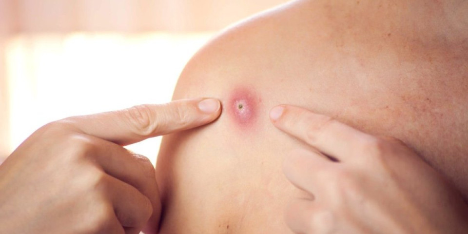 7 bolesti koje uzrokuju kvržice na telu: Ovo su najčešći uzroci, nisu svi razlog za paniku