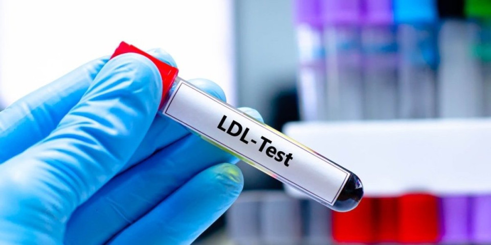 Tihi ubica u krvi: Kardiolozi tvrde da 1 promena čisti organizam od lošeg holesterola