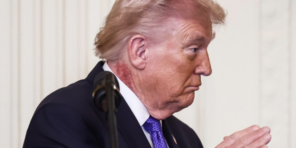 Oglasio se Trampov lekar: Evo odakle mu krasta na vratu! (FOTO)