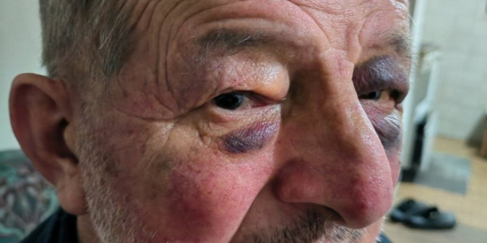 Brutalno prebijanje pacijenta: Prijepolje u šoku - zdravstveni radnik krvnički napao muškarca koji je samo tražio pomoć