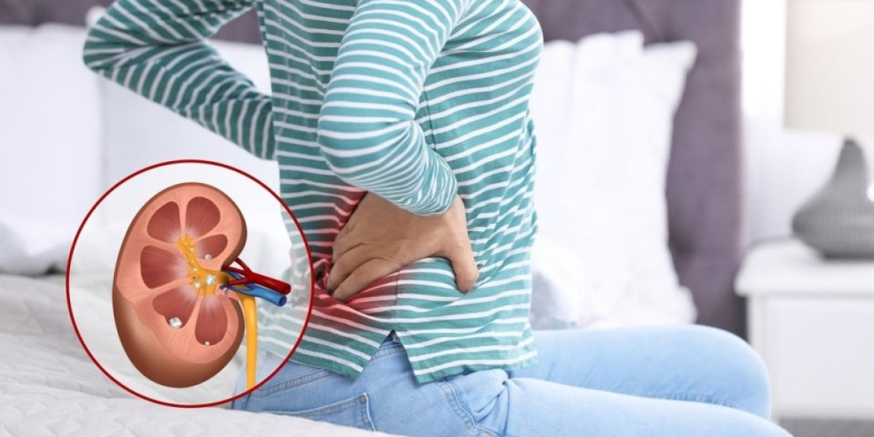 Gde tačno boli kamen u bubregu? Prepoznajte opasne simptome na vreme - lekari upozoravaju