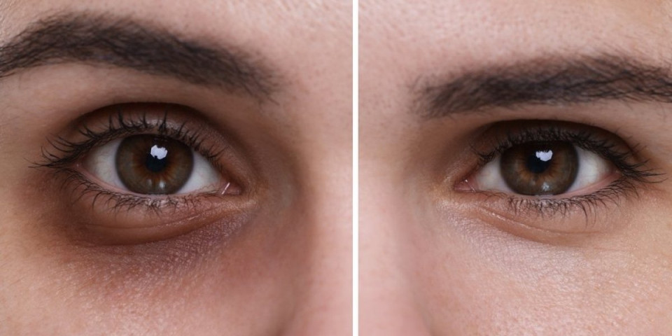 Zaboravite na podočnjake: Trik koji ih briše preko noći - dermatolozi oduševljeni