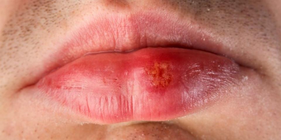 Ovo na usnama može biti znak raka: Deluje kao obična promena, a ustvari je mnogo gore