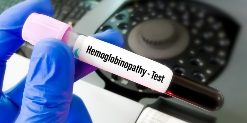 Namirnice koje dižu hemoglobin preko noći: Krvna slika se popravlja kao luda
