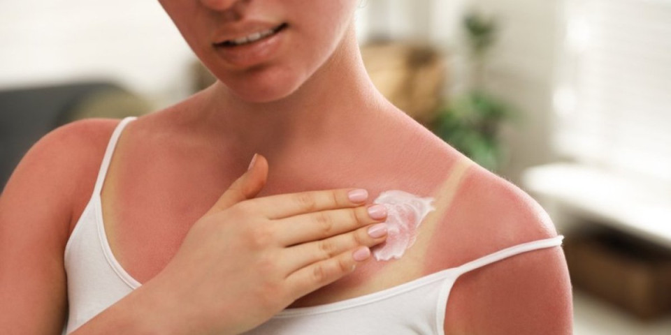Spas za opekotine od sunca: Smesa od 2 sastojka iz frižidera umiruje kožu