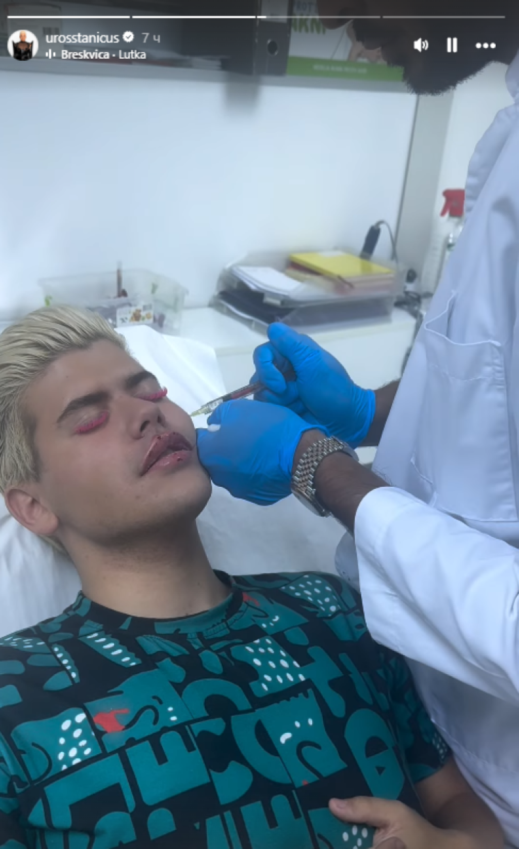 Usta napupela od hijalurona! Uroš Stanić otišao na remont - Nacia zanemela zbog šok prizora