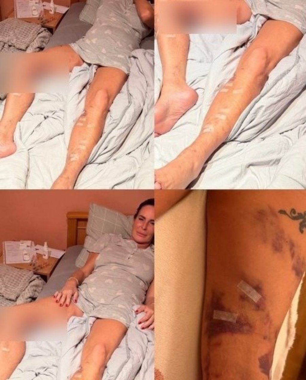 Uznemirujući prizor! Kačavenda cela u modricama i podlivima - Evo koga krivi za tumor