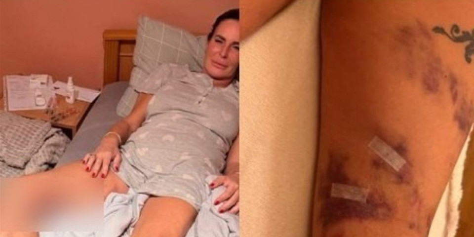 Uznemirujući prizor! Kačavenda cela u modricama i podlivima - Evo koga krivi za tumor